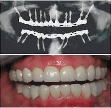 Teeth x-ray