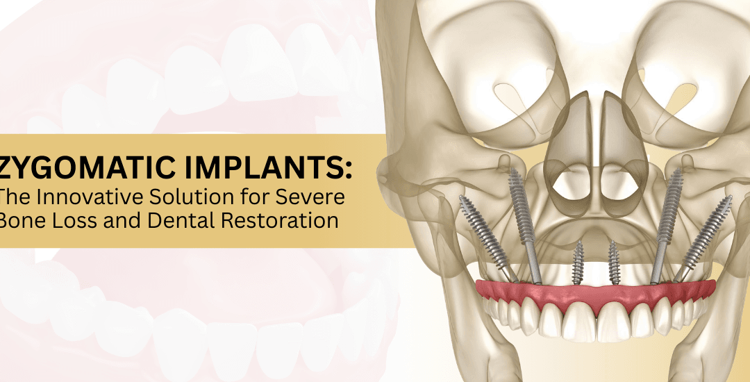 Are Zygomatic Implants a Solution for Extreme Bone Loss Cases?