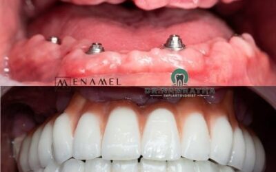 Why Patients Travel to India for Full Mouth Dental Implants & How to Choose the Right Clinic