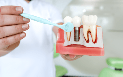 Dental Implants