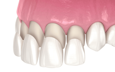 What’s the difference between veneers and crowns?