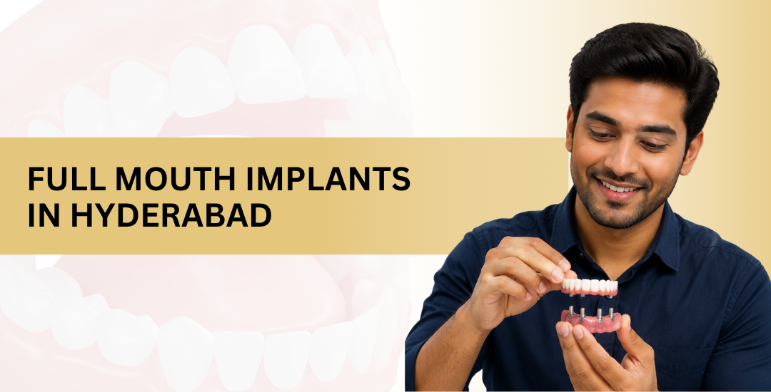 Full Mouth Implants in Hyderabad