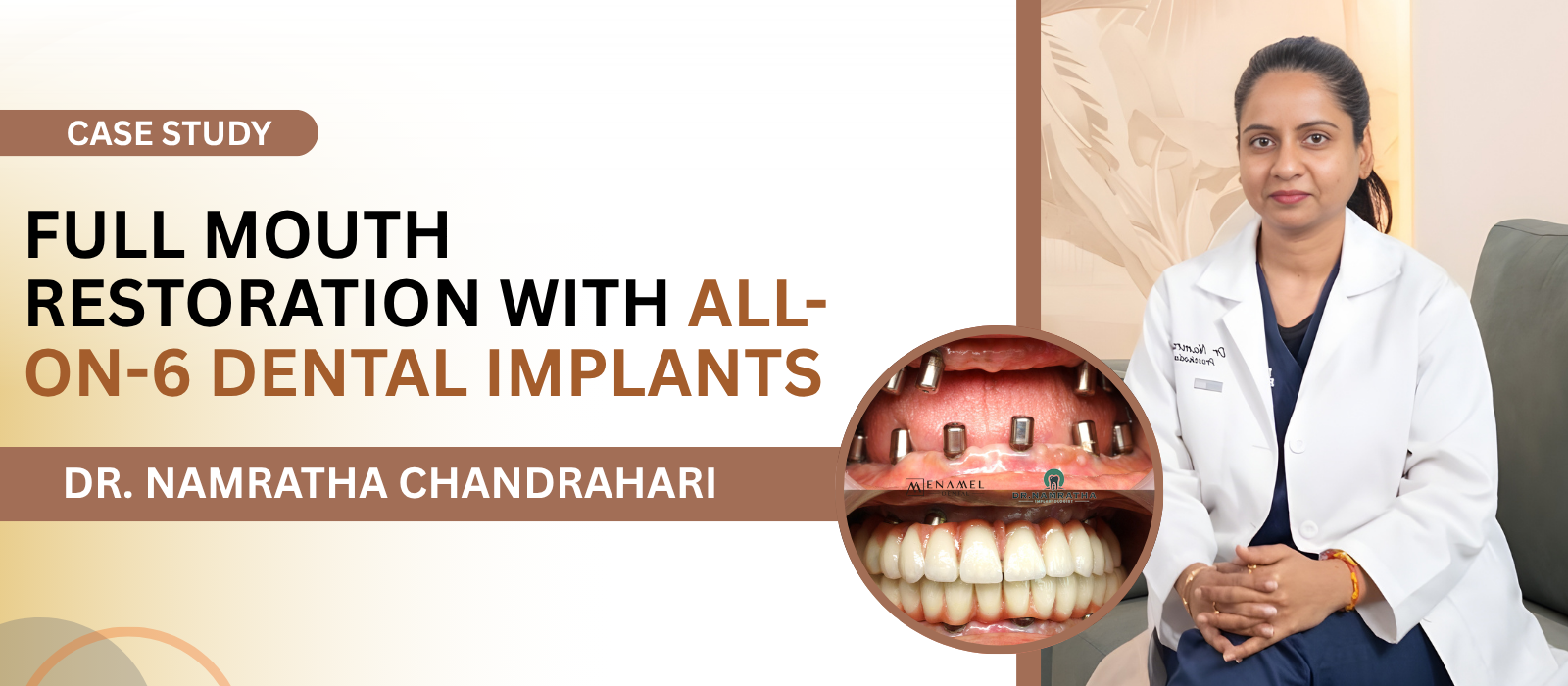 Full Mouth Restoration with All-on-6 Dental Implants
