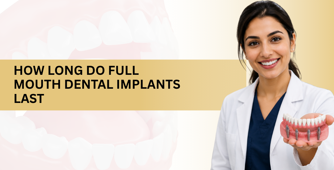 How Long Do Full Mouth Dental Implants Last