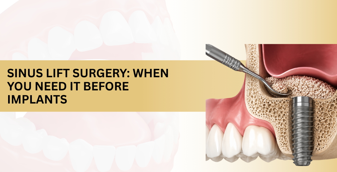 Sinus Lift Surgery When You Need It Before Implants