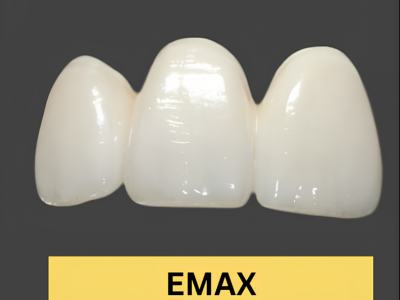 Three front dental crowns made of EMAX lithium disilicate shown on a dark background, with the label 'EMAX' beneath.