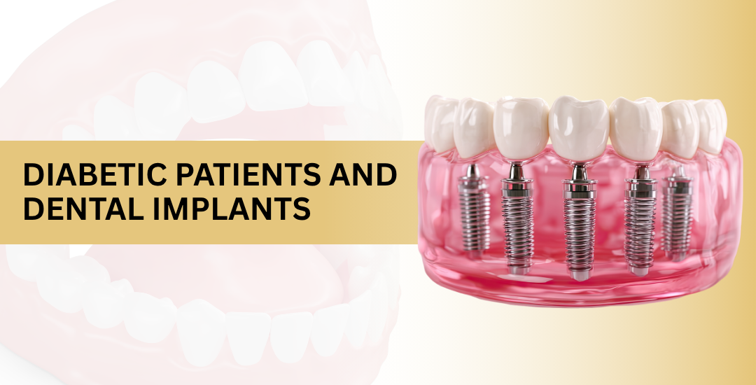 Diabetic Patients Can Get Dental Implants With Proper Glycemic Control?
