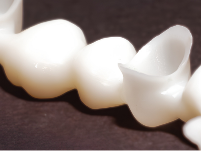 Close-up of a dental bridge with connected crowns on a row of teeth, showing smooth enamel surfaces.