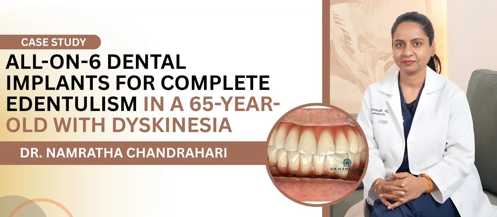 All-on-6 Dental Implants for Complete Edentulism