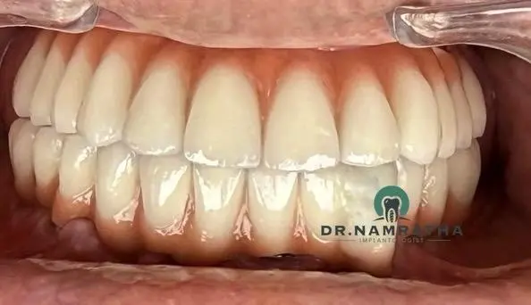 Close-up of a full set of white dentures in a patient's mouth, showing both upper and lower arches.
