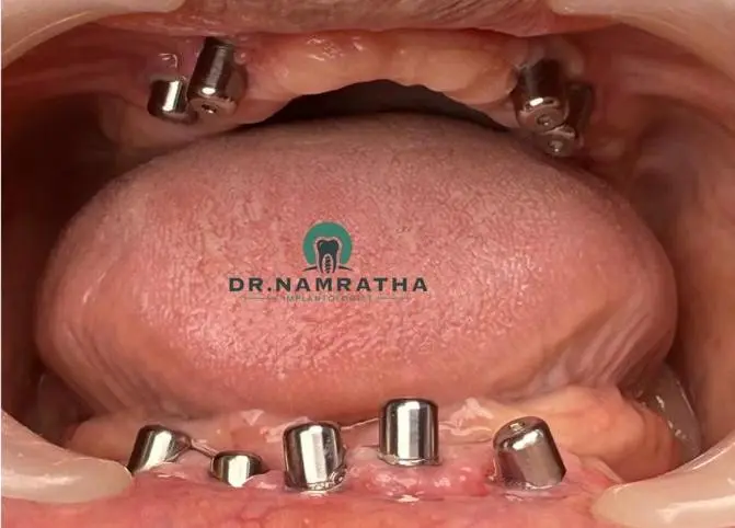 Close-up of a lower jaw with multiple dental implants visible along the gum line, awaiting crown placement (watermark: DR.NAMRATHA).