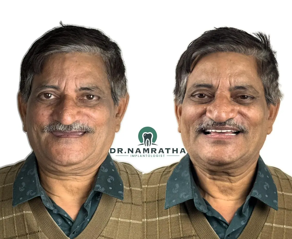 Side-by-side photos of a man before and after dental implants, with Dr. Namratha Implantologist logo between.