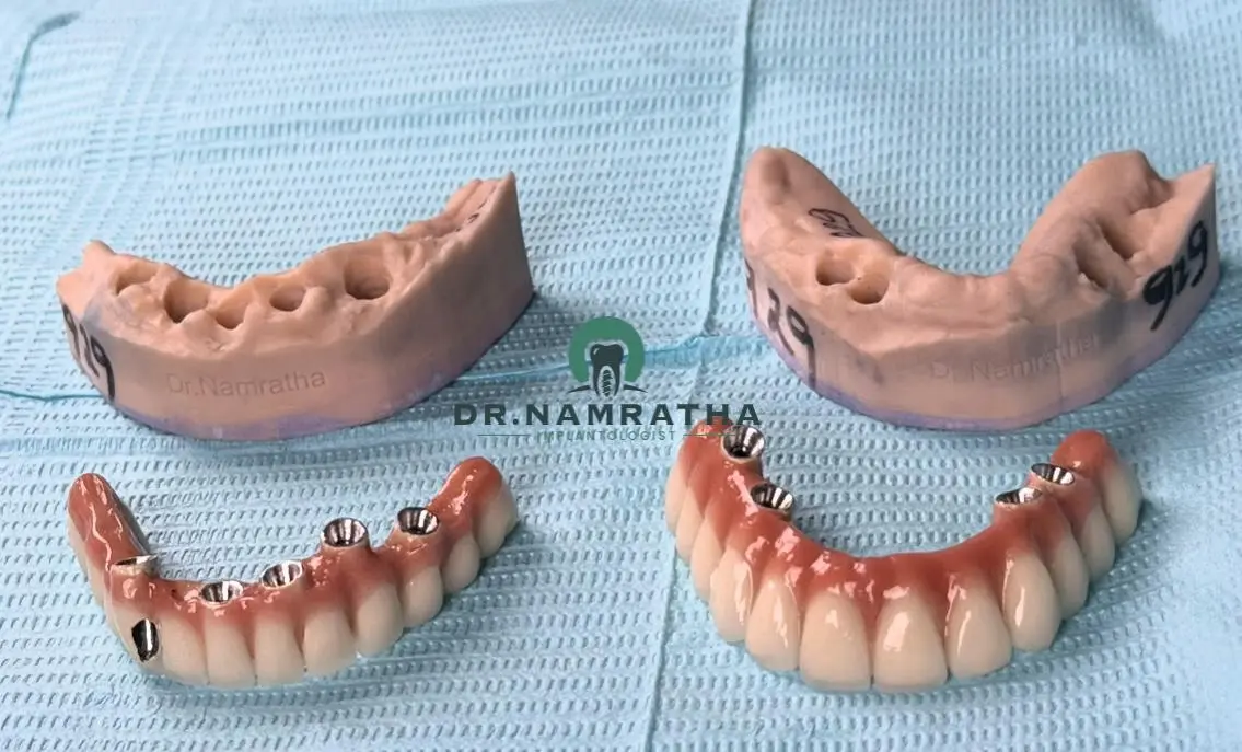 Upper and lower dental models with implant-supported dentures and crown abutments.