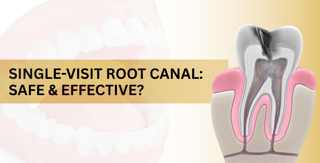 Is a Single-Visit Root Canal Actually Safe and Effective?