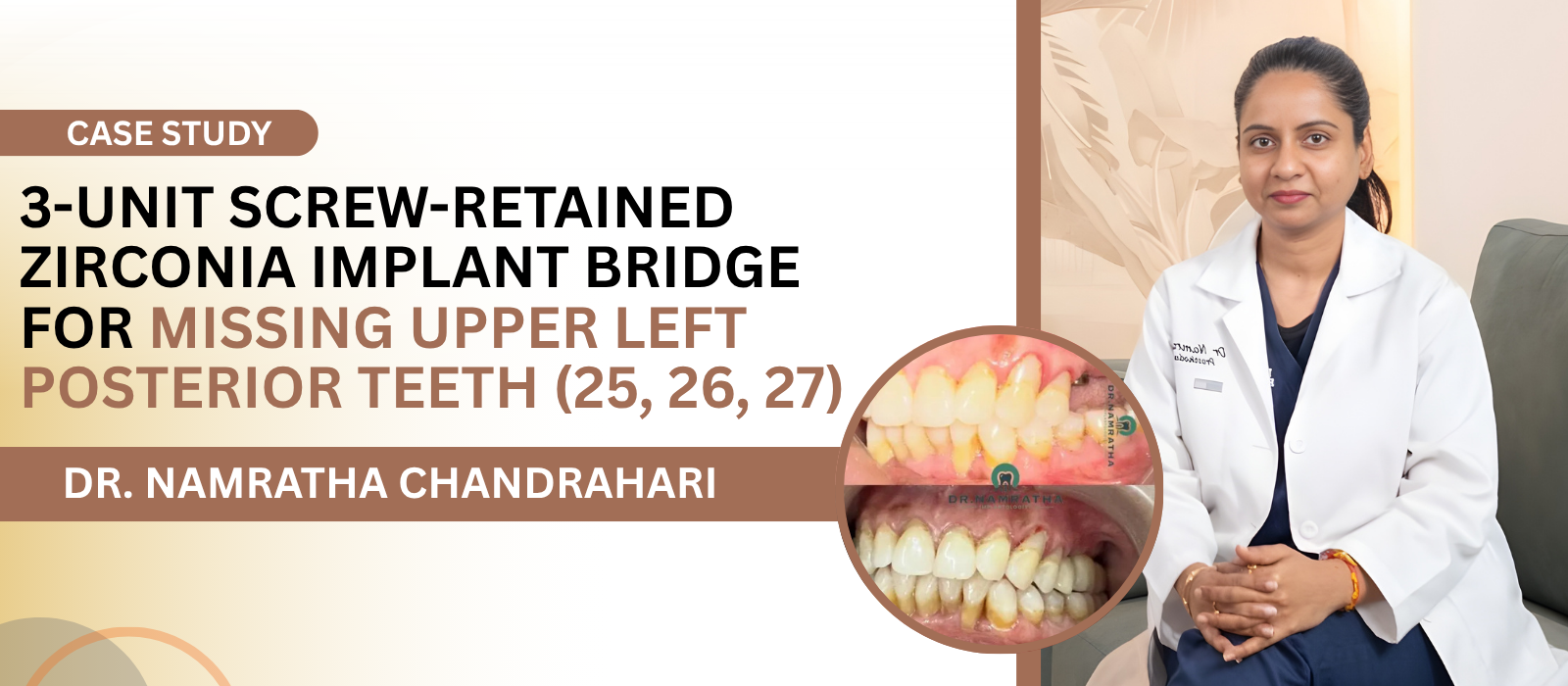 3-Unit Screw-Retained Zirconia Implant Bridge for Missing Upper Left Posterior Teeth 25 26 27