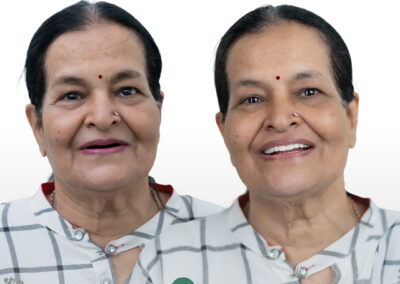 Side-by-side portrait of a woman before and after dental treatment, showing an improved, full smile with visible teeth.