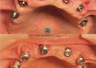 Two views of the upper jaw showing multiple dental implants with healing abutments in place, preparing for an implant-supported denture.