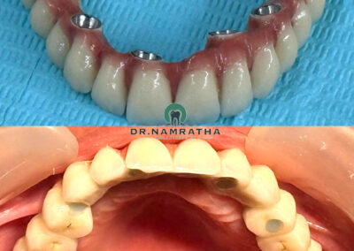 Upper jaw with an implant-supported full-arch prosthesis; metal implant abutments are visible through pink gum-colored material in a curved dental bridge layout.