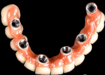 Lower jaw dental model with multiple dental implants and abutments visible along the gum line against a black background.