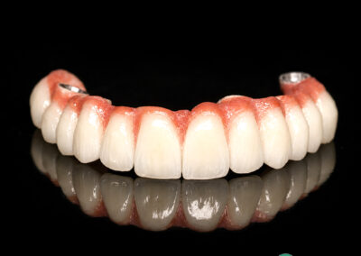 Full-arch implant-supported denture on a black background with pink gums and white teeth.