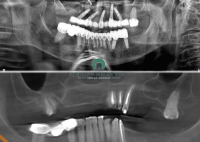 Panoramic dental X-ray showing multiple upper and lower implants with crowns and a fixed bridge, plus natural teeth and jawbone details.