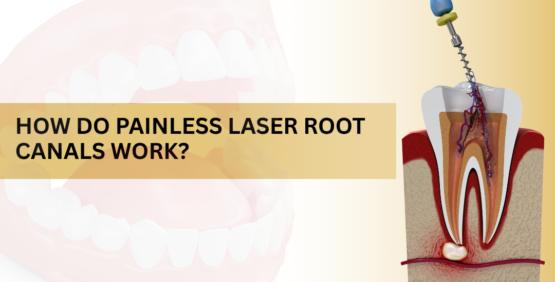 How Do Painless Laser Root Canals Work?
