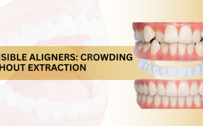 How Do Invisible Aligners Fix Crowding Without Extraction?