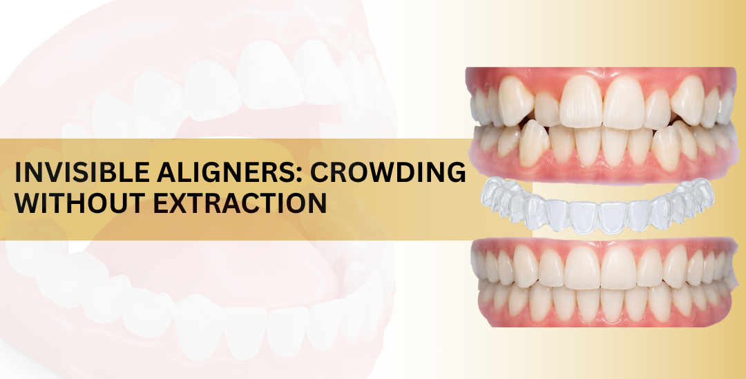Invisible Aligners Crowding Without Extraction
