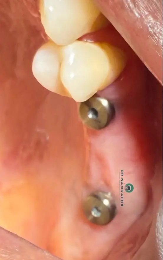 Two dental implants anchored in the lower jaw with crowns attached, showing a partial dental restoration.