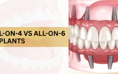 All-on-4 vs All-on-6 Implants: Which One Is Right for You?