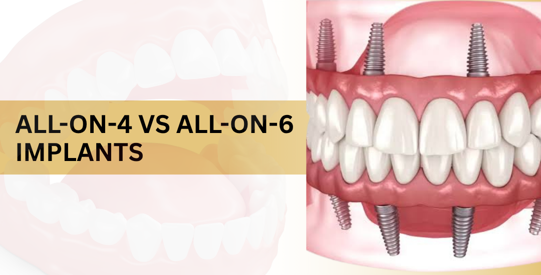 All-on-4 vs All-on-6 Implants