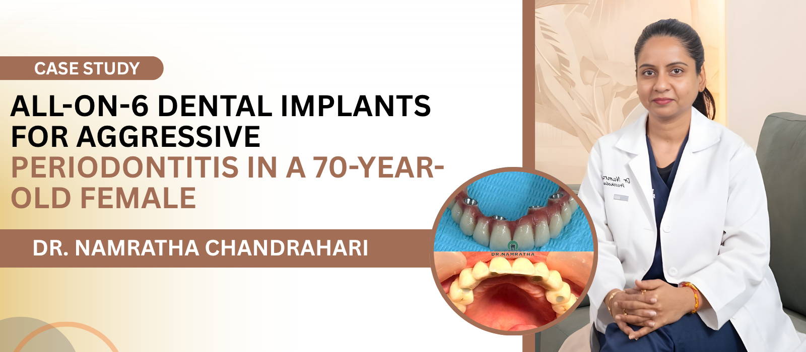 All-on-6 Dental Implants for Aggressive Periodontitis in a 70-Year-Old Female | Enamel Dental All-on-6 Dental Implants for Aggressive Periodontitis in a 70-Year-Old Female