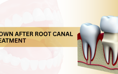 Do You Need a Crown After a Root Canal Treatment?