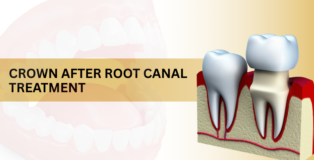 Crown After Root Canal Treatment