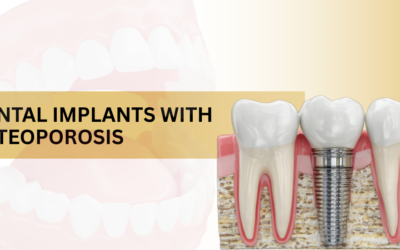 Can You Get Dental Implants If You Have Osteoporosis?