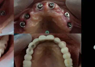 Patients shown with dental implants, full-arch dentures, and bite X-rays illustrating full-mouth rehabilitation across multiple views