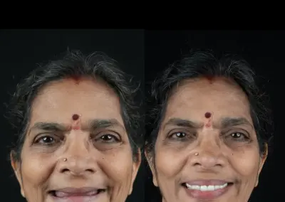 Before-and-after portrait of a woman showing improved, even smile after dental treatment.