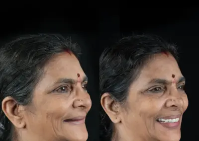 Before-and-after portrait of a woman showing an improved smile after dental treatment; left side pre-treatment, right side post-treatment with whiter teeth.