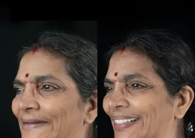 Before-and-after side-by-side photo of a woman: left with a natural smile, right with a bright, white smile after dental treatment (dr. Namratha).