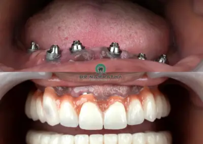 Before-and-after dental implant restoration showing upper jaw with abutments and a full lower denture with implants and artificial teeth, logo visible