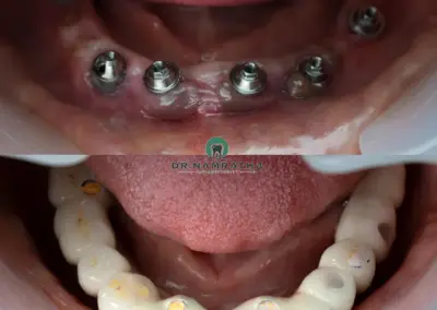 Six dental implants placed along the lower jaw with healing abutments visible (pre‑prosthetic stage). Inset shows a lower full‑arch implant-supported denture with artificial teeth.