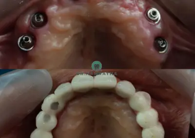 Maxillary dental implants with healing abutments visible (upper jaw); surrounding tissue inflamed from surgery.