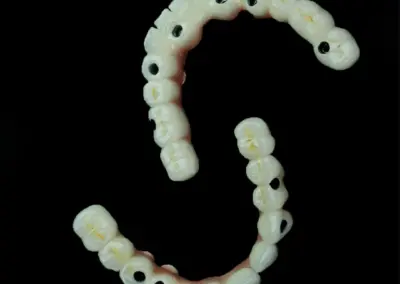 Implant-supported dental prosthesis: a curved arch of white crowns with visible screw holes for implants against a black background