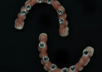 Full-arch implant-supported denture pieces on a dark surface.