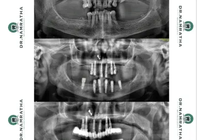 Three-panel panoramic dental X-ray showing multiple implants in upper and lower jaws with prosthetic restorations.