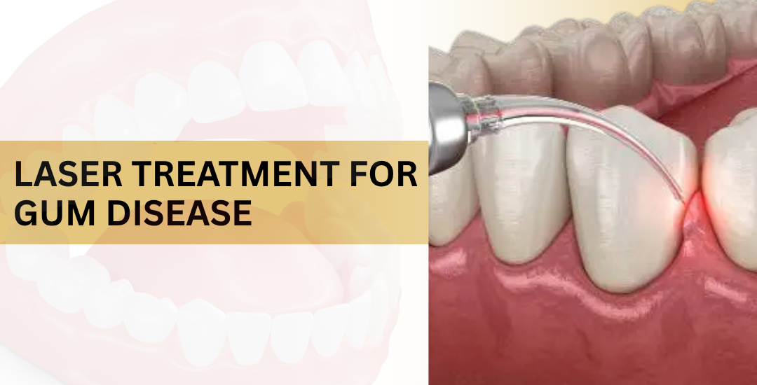 Laser Treatment for Gum Disease