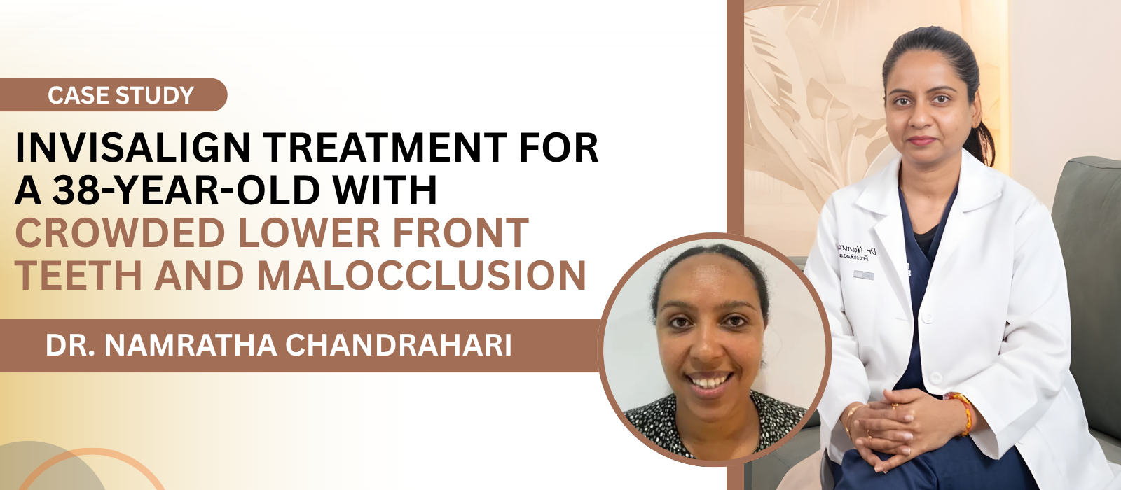 Invisalign Treatment for a 38-Year-Old with Crowded Lower Front Teeth and Malocclusion | Enamel Dental Invisalign Treatment for a 38-Year-Old with Crowded Lower Front Teeth and Malocclusion